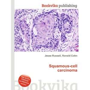  Squamous cell carcinoma Ronald Cohn Jesse Russell Books